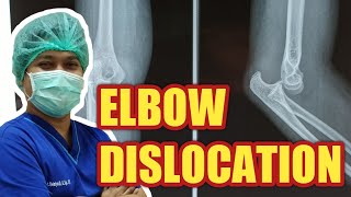 Kasus Ortopedi Dislokasi Sendi Siku Elbow Dislocation [upl. by Ahsirpac]