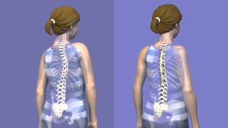 What is Scoliosis surgery [upl. by Yrffoeg]