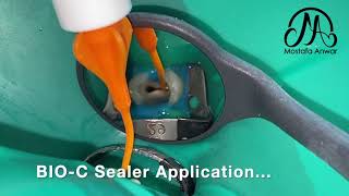 BIOC Sealer Application in Confluent Root Canals  How to Apply BioCeramic Sealer for Obturation [upl. by Seem]