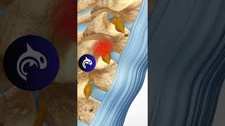 Cervical Selective Nerve Root Block SNRB anatomy orthopedics spine [upl. by Perle]