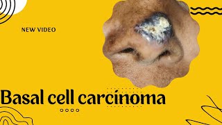 BASAL CELL CARCINOMA  ADENOID VARIANT [upl. by Hannasus]