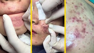 ASMR Remove blackheads new this week blackhead asmr satisfyingvideo [upl. by Leia]