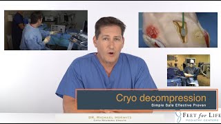 Cryo neuroma decompression update 2023 [upl. by Ainslee]