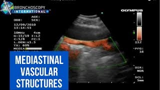 BronchAtlas EBUS and Suspected Pulmonary Embolism [upl. by Adler]