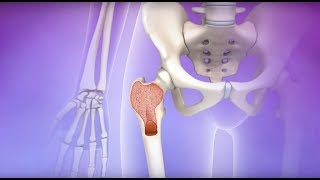 Myelofibrosis  Mayo Clinic [upl. by Bloem766]