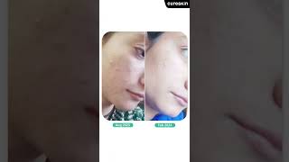 Acne reduced in 3 months  A cureskin review [upl. by Oiramed11]