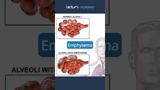 Exploring Emphysema 🔍 Emphysema RespiratoryCare nclexrn [upl. by Theodor248]