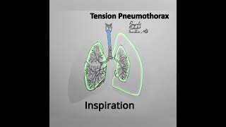 Tension Pneumothorax Animation variation 4 shorts medical [upl. by Sikleb781]