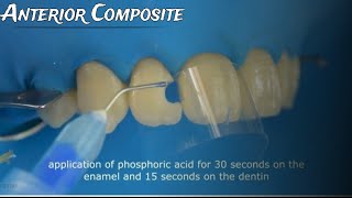 Class III Composite restoration Full case protocol from A to Z [upl. by Shanie]