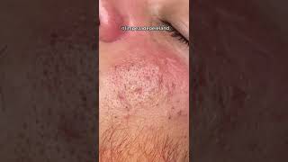 EXTRACTION ACNES SEVERE SUR LA JOUE PAR UN MEDECIN acne acnetreatment santé boutons [upl. by Novat]