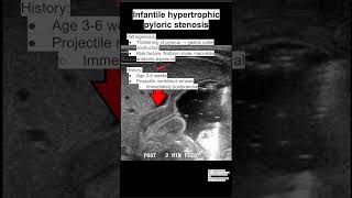 Infantile hypertrophic pyloric stenosis [upl. by Madelena196]