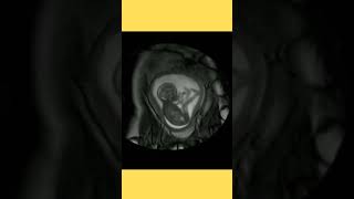 baby movementfetal movementbaby movement in pregnancybaby movement in womb [upl. by Aileno599]