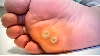 How To Remove a Foot Corn or Callus Foot Doctor Home Treatment [upl. by Onibla]