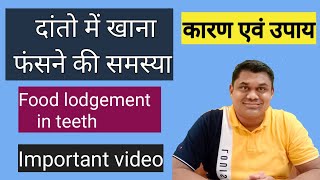 दातों में खाना फंसने की समस्या Food Lodgement In Teeth Danto Me Khana Fasne Ki problem amp Solution [upl. by Hervey]