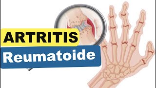 ARTRITIS REUMATOIDE  Síntomas Diagnóstico Tratamiento [upl. by Irek]