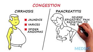 Splenomegaly Remember the 3 primary causes with CIP [upl. by Calloway]