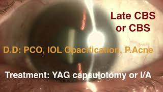 Late Capsular Distention Capsular block  Syndrome Management [upl. by Caia]