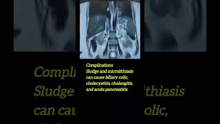 gallbladder sludge with microlithiasis [upl. by Anyaj]