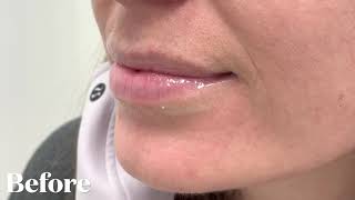 Watch This Lip Filler Transformation With Just One Syringe Of Juvéderm Volbella [upl. by Sutsuj]