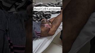 Basal Cell Carcinoma Case  Doctor Strange medico cancer carcinoma surgery mbbs doctor shorts [upl. by Nnilsia]