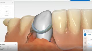 Cerec Primescan  Crown under partial denture [upl. by Ecinnej]