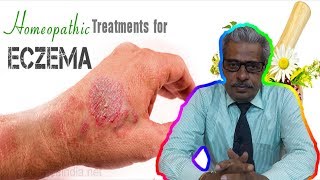 Eczema Dermatitis Treatment in Homeopathy by Dr PS Tiwari [upl. by Elizabet689]