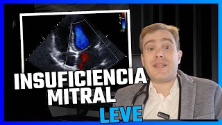 Insuficiência Mitral Leve o que você deve pensar quando vê esse resultado no ecocardio [upl. by Prakash]