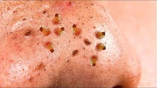 Horrible BLACKHEADS on nose removal [upl. by Olivann]