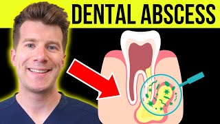 Doctor explains DENTAL ABSCESS tooth abscess  Causes symptoms amp treatment [upl. by Zennas]