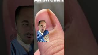 Subungual melanoma in the nail  Doctor reacts striate melanonychia subungualmelanoma [upl. by Jdavie]