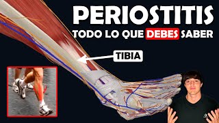 PERIOSTITIS TIBIAL Su TRATAMIENTO y lo que debes saber [upl. by Yelmene]