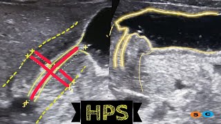 Hypertrophic pyloric stenosis [upl. by Adien]