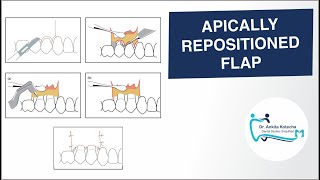 APICALLY REPOSITIONED FLAP PERIODONTAL FLAP SURGICAL TECHNIQUE DR ANKITA KOTECHA [upl. by Eimrots403]