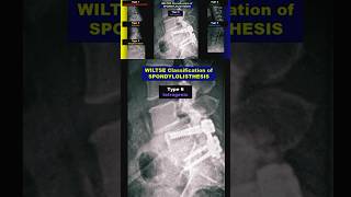 Spondylolisthesis  Wiltse Classification radiology bones spine xray [upl. by Aramit]