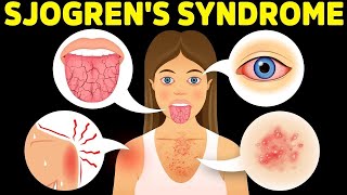 The Best Protocol for Sjogrens Syndrome [upl. by Rolecnahc]