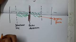 spigelian hernia II surgery mp4 [upl. by Malinde60]