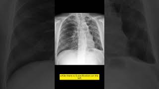 Decoding Chest Xray Bilateral Tuberculosislike Changes amp More chestxray [upl. by Htiffirg]