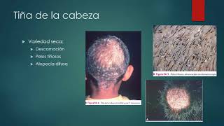 16 DERMATOLOGÍA Dermatofitosis [upl. by Nelsen]