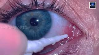 Mucus fishing Syndrome explained indetail eyecareoptom5506 optometry eye eyelid optometrist [upl. by Laira]