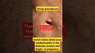 striae gravidarum how to remove stretch marksshorts youtubeshortstrending viralvideopregnancy [upl. by Eilime5]