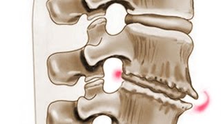 Osteoxondroz və onun müalicəsi  Остеохондроз Симптомы и лечение остеохондроза [upl. by Lahsram]