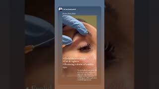 Expert Eyelid Rejuvenation with Advanced Fillers at EDEN AESTHETICS Dubai [upl. by Zuckerman532]