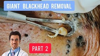 Massive blackhead removal inside a dermatology clinic  DrAMAZINGSKIN [upl. by Guyon]