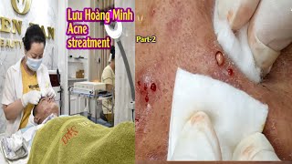 Acne treatment reputation effective at Hien Van Spa381I Lưu hoàng Minhpart2 [upl. by Treblih]