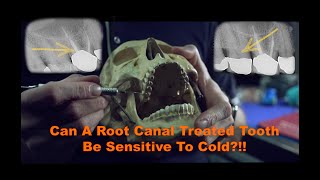 Can a root canal treated tooth be sensitive to cold [upl. by Leahcimnaes]