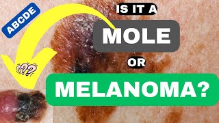 ABCDE of Melanoma Is it a Mole or Melanoma  ABCDE of Skin Cancer  Skin Cancer Symptoms and Signs [upl. by Targett]