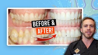 Adult Braces Overbite Treatment BEFORE amp AFTER [upl. by Eniroc]