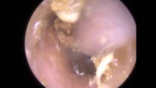 178 Removal of Ear Wax reveals Signs of Otomycosis  Mr Neel Raithatha The Hear Clinic [upl. by Gereld776]