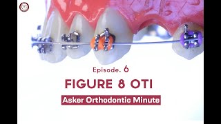 Figure 8 Oti Asker Orthodontic Minute Episode 6 [upl. by Juliano]