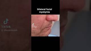 bilateral hemifacial myokymia [upl. by Halden]